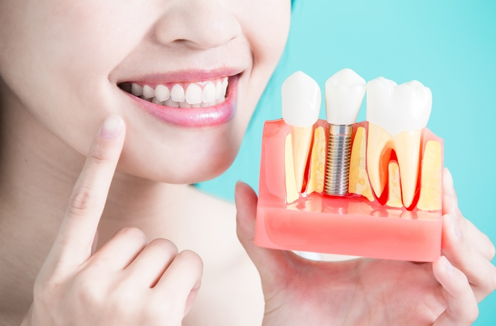 Rediscover Your Smile: The Life-Changing Power of All-on-4 Dental Implants