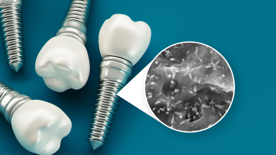 The Role of Nanotechnology in Optimising Dental Implant Success - selman tech || selmantech com || selmantech com app download