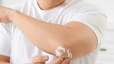 Should Eczema Lotion Sting When You Put It On?