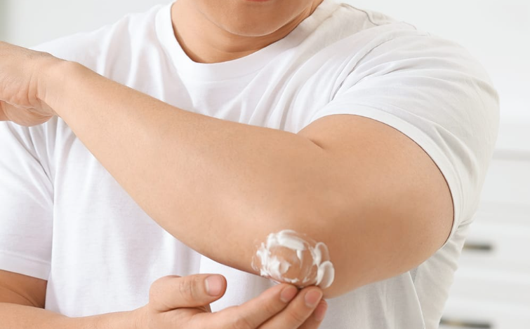 Should Eczema Lotion Sting When You Put It On?