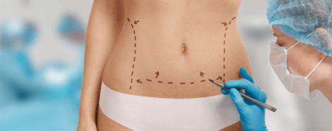 Tummy Tuck