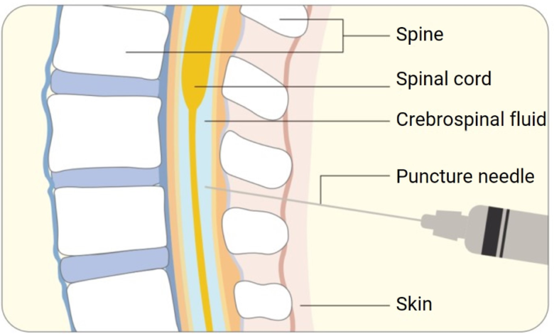 How Does the Intrathecal Route Deliver Drugs?